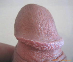 Pearly-Penile-Papules-Picture-1