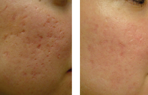 prima e dopo laser acne