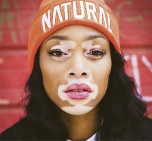 top-model-vitiligo