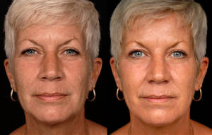 Laser Skin Resurfacing: prima e dopo