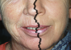 Ringiovanimento viso: prima e dopo