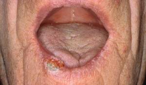 Carcinoma spinocellulare labbro