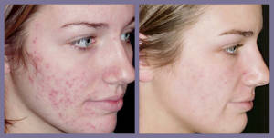 prima e dopo laser su cicatrici da acne