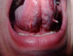 warts-on-tongue-pictures